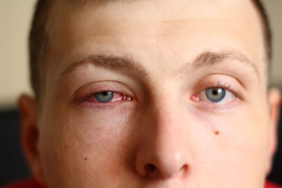 Cara mengobati sakit mata dengan cara alami 